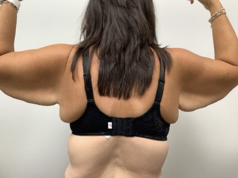 Brachioplasty Before & After Image