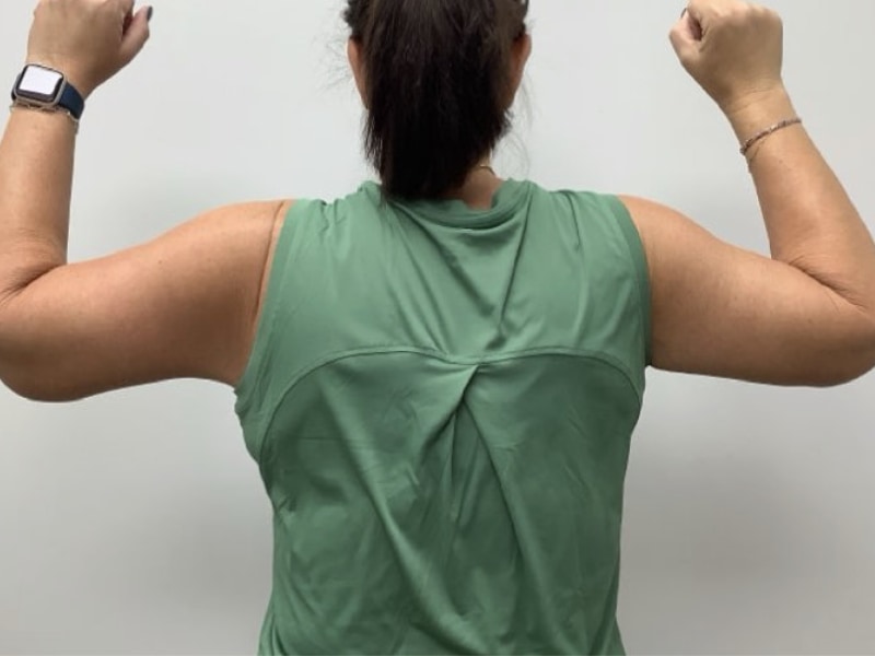 Brachioplasty Before & After Image