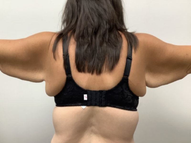 Brachioplasty Before & After Image