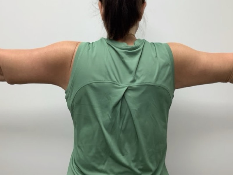 Brachioplasty Before & After Image