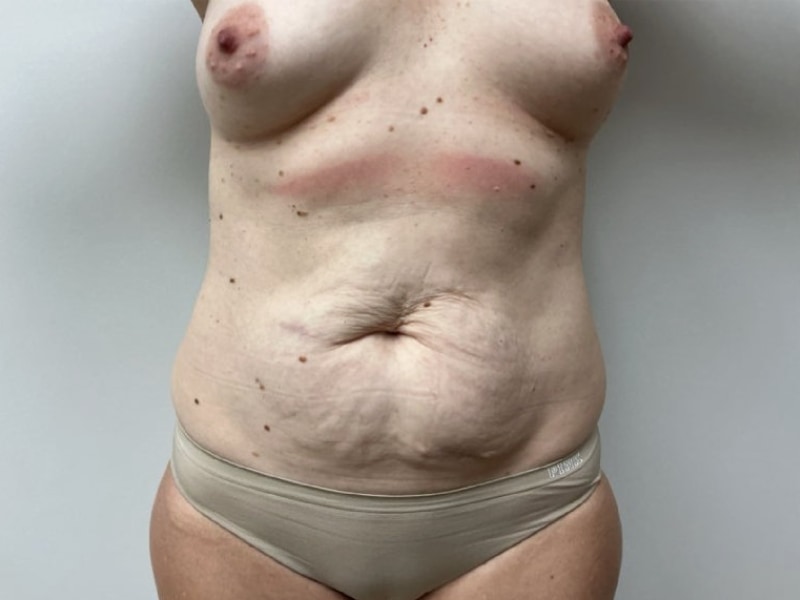 Mommy Makeover Before & After Image
