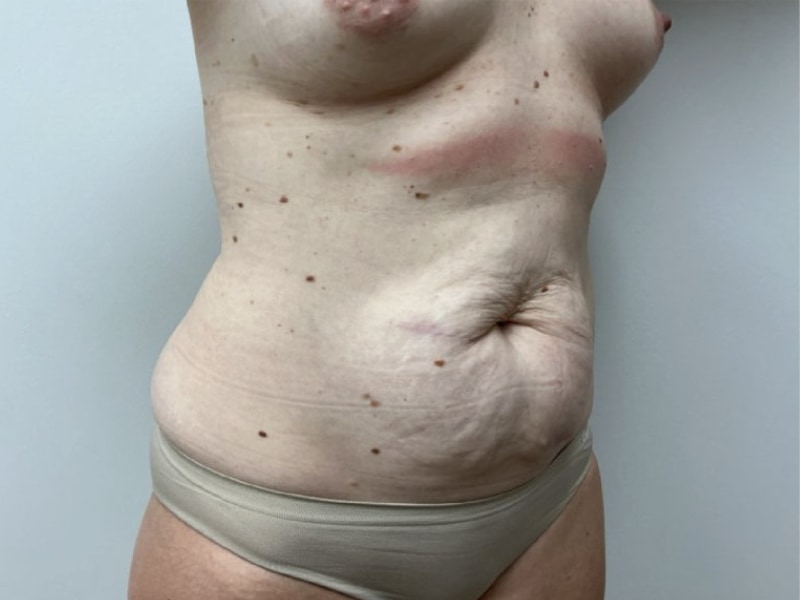 Mommy Makeover Before & After Image