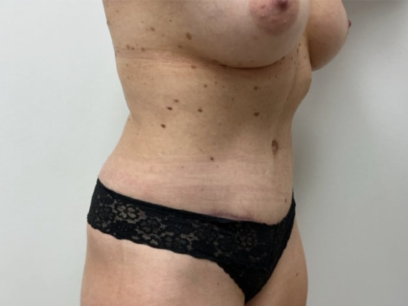 Mommy Makeover Before & After Image