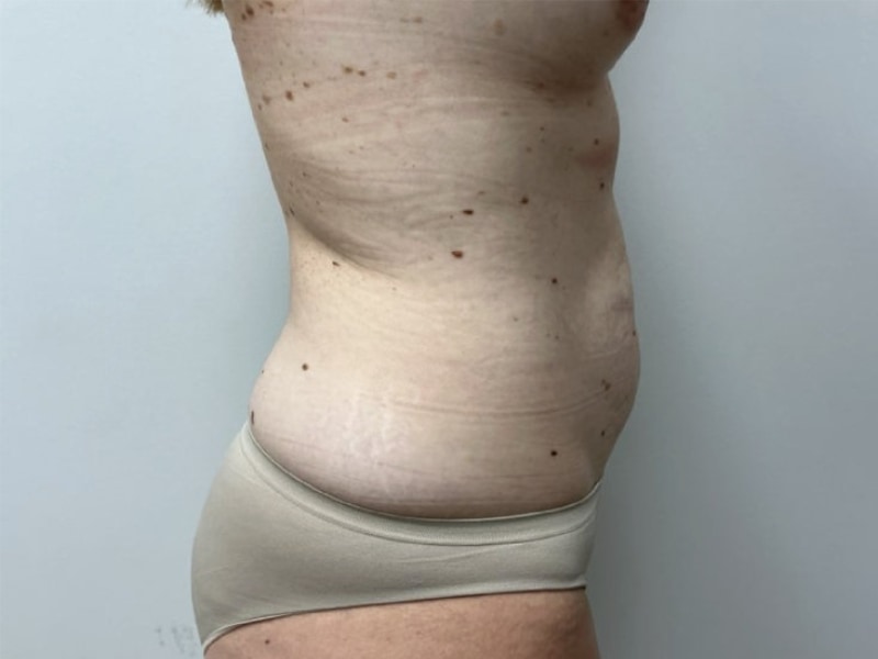 Mommy Makeover Before & After Image