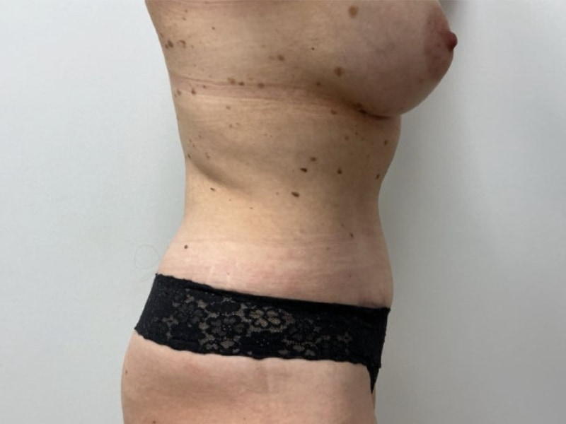 Mommy Makeover Before & After Image