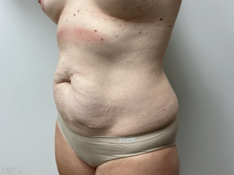 Mommy Makeover Before & After Image