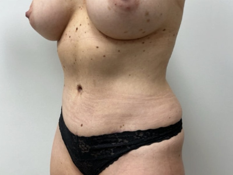 Mommy Makeover Before & After Image