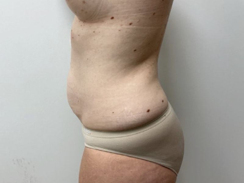 Mommy Makeover Before & After Image