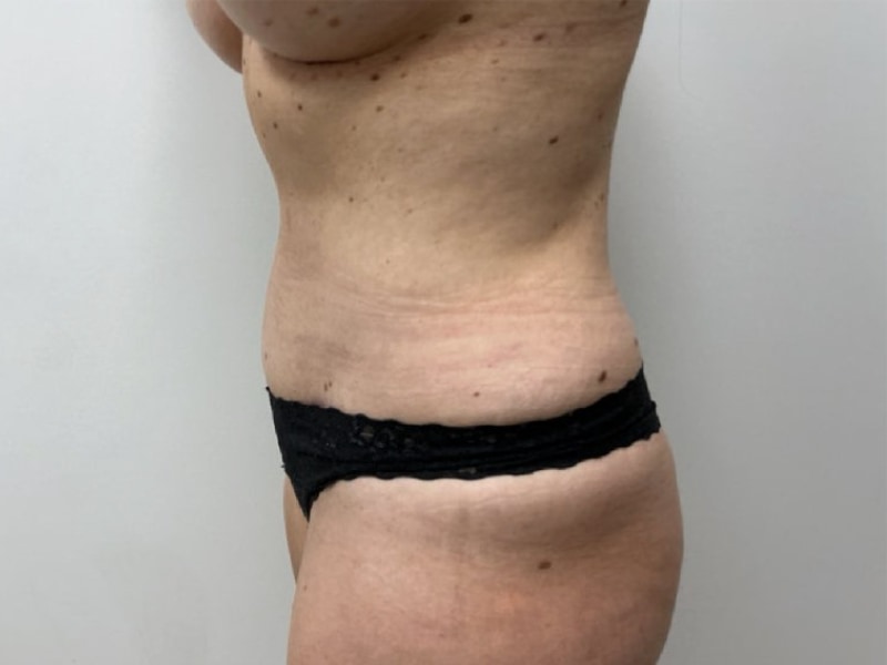 Mommy Makeover Before & After Image