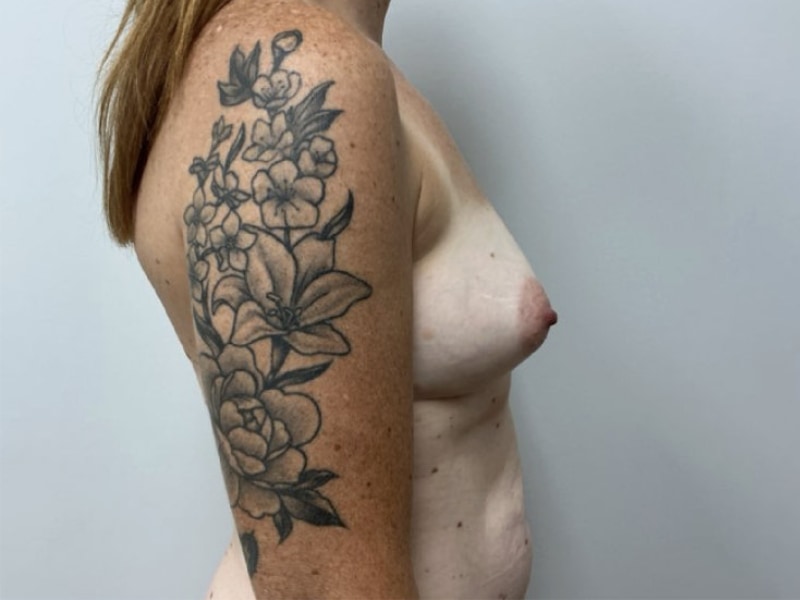 Mommy Makeover Before & After Image