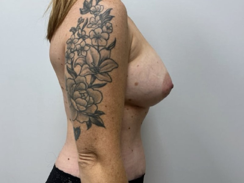 Mommy Makeover Before & After Image