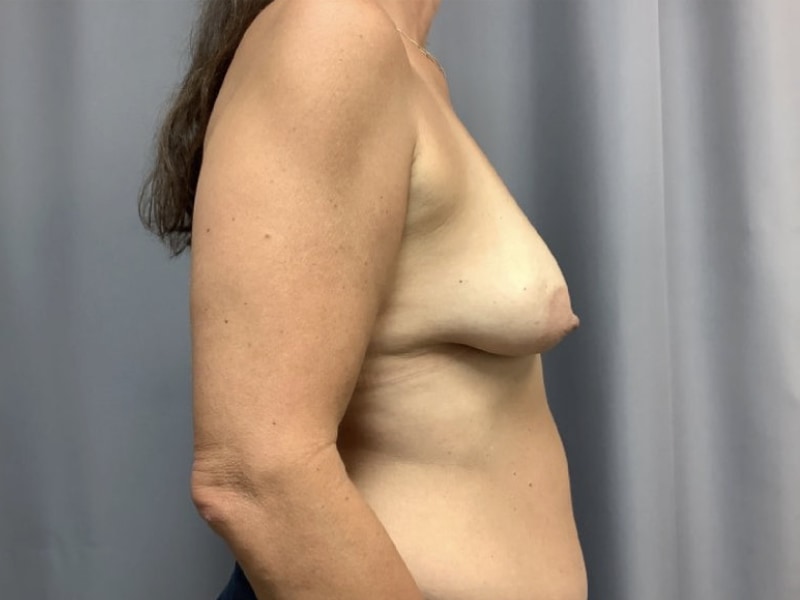 Breast Augmentation with Lift Before & After Image