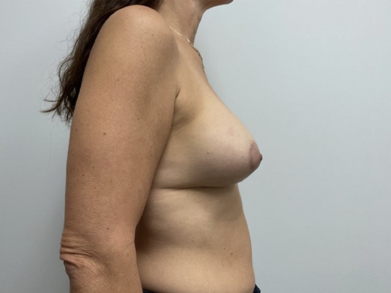 Breast Augmentation with Lift Before & After Image