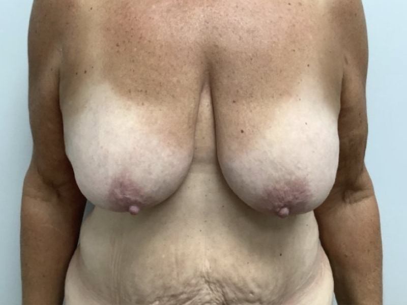 Breast Augmentation with Lift Before & After Image