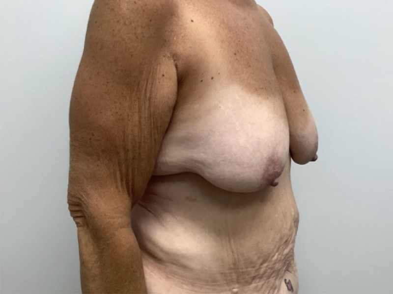 Breast Augmentation with Lift Before & After Image