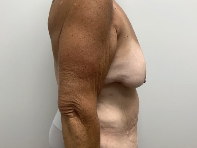 Breast Augmentation with Lift Before & After Image