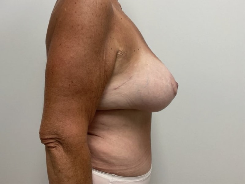 Breast Augmentation with Lift Before & After Image