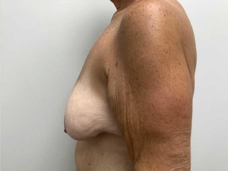 Breast Augmentation with Lift Before & After Image