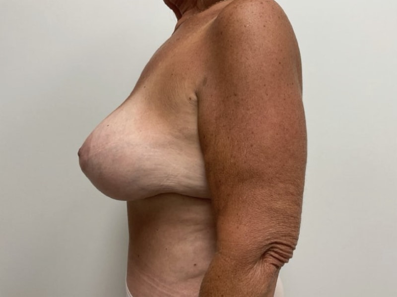 Breast Augmentation with Lift Before & After Image