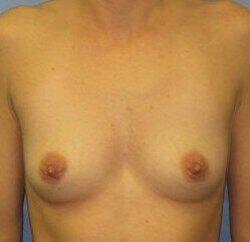 Breast Augmentation Before & After Image