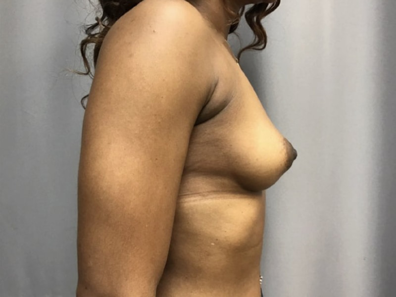 Breast Augmentation Before & After Image