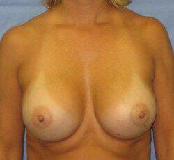 Breast Augmentation Before & After Image