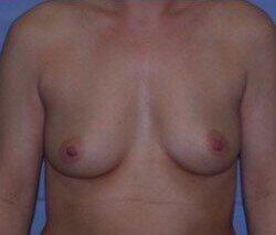 Breast Augmentation Before & After Image