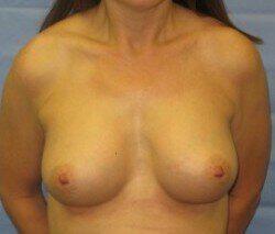 Breast Augmentation Before & After Image