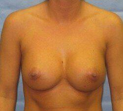 Breast Augmentation Before & After Image