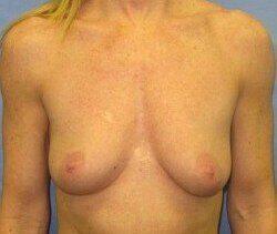 Breast Augmentation Before & After Image