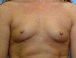 Breast Augmentation Before & After Image