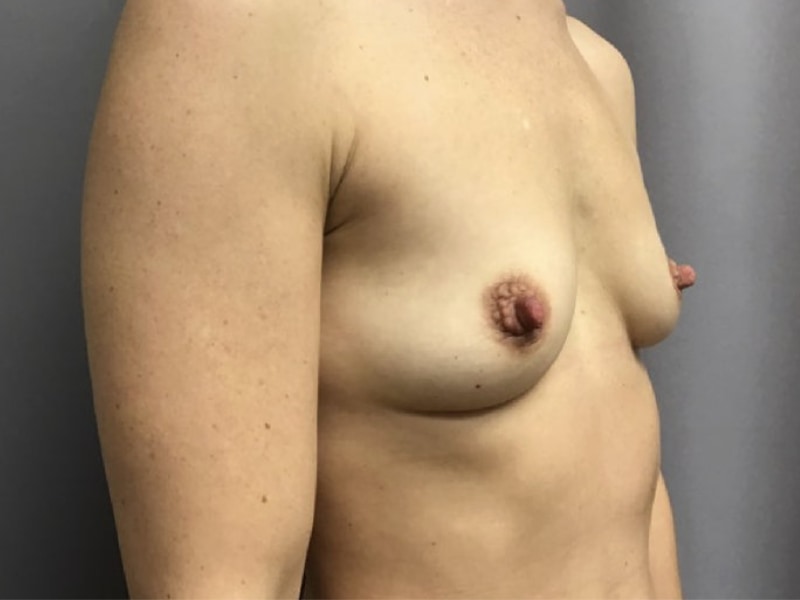 Breast Augmentation Before & After Image