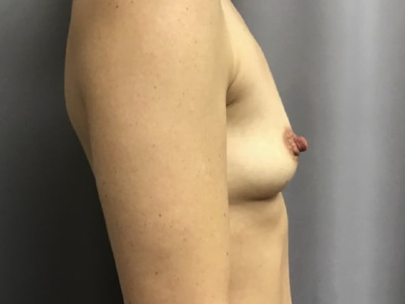 Breast Augmentation Before & After Image