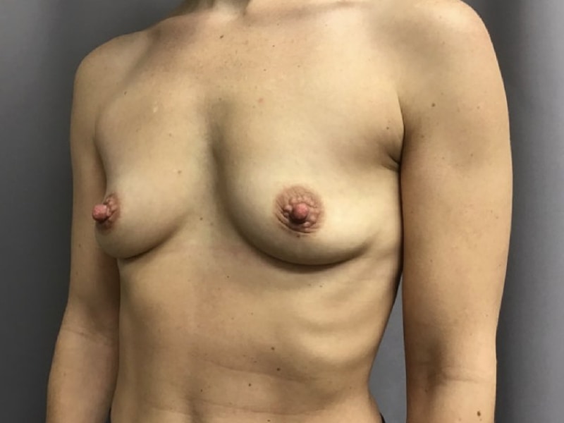Breast Augmentation Before & After Image