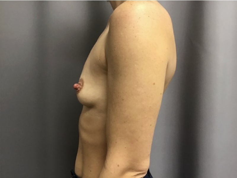 Breast Augmentation Before & After Image