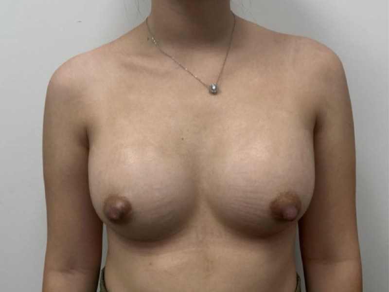 Breast Augmentation Before & After Image