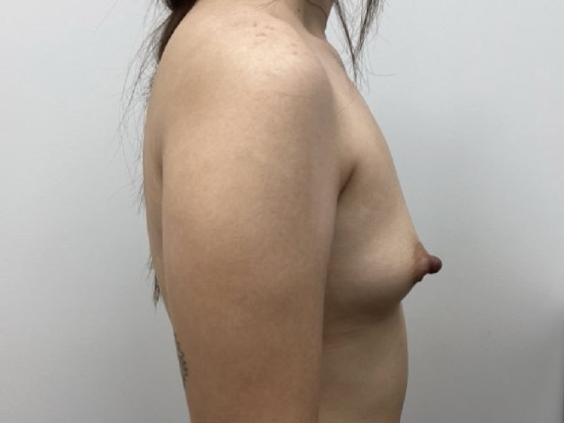 Breast Augmentation Before & After Image