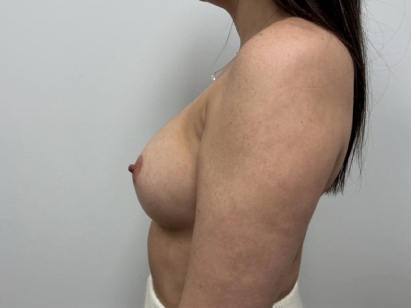 Breast Augmentation Before & After Image