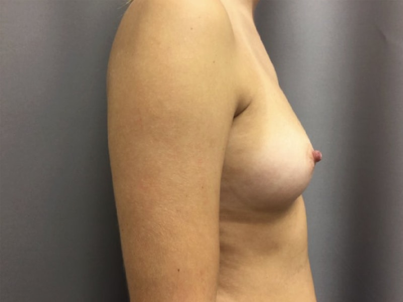 Breast Augmentation Before & After Image