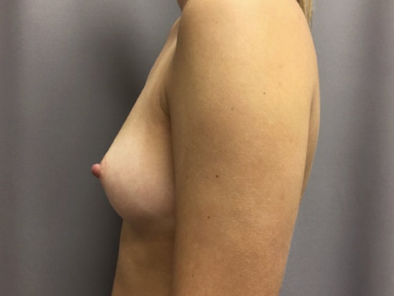 Breast Augmentation Before & After Image