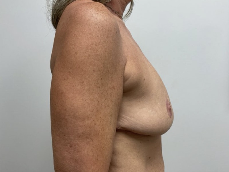 Breast Augmentation Before & After Image