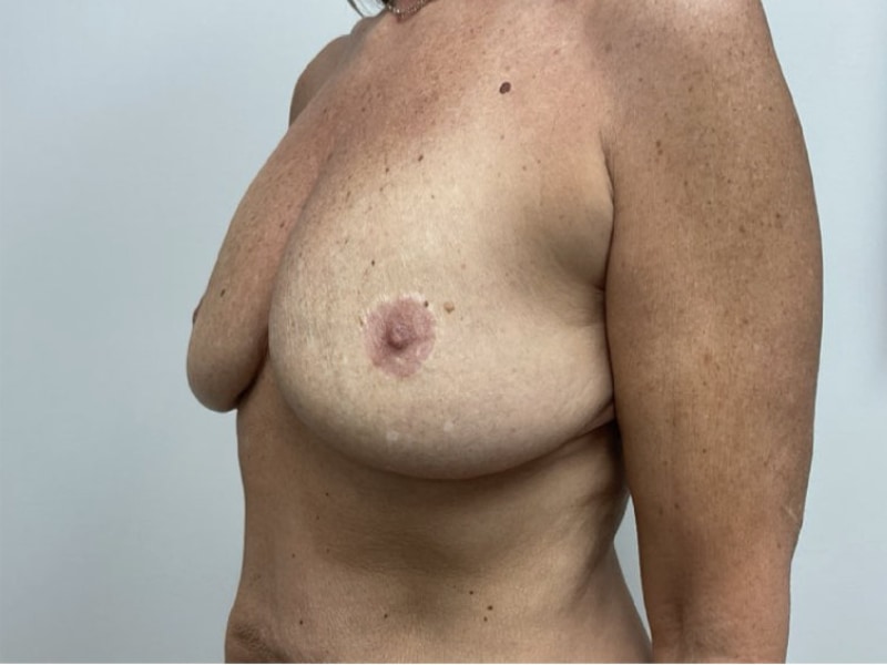 Breast Augmentation Before & After Image