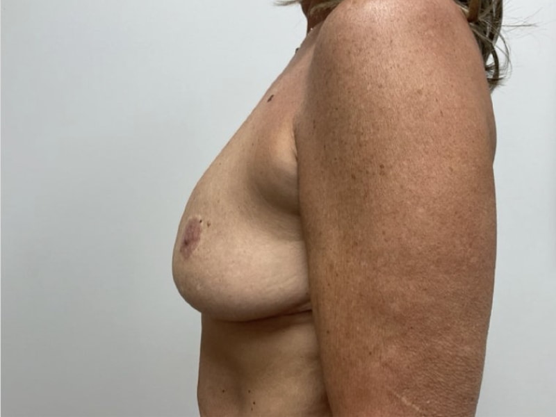 Breast Augmentation Before & After Image