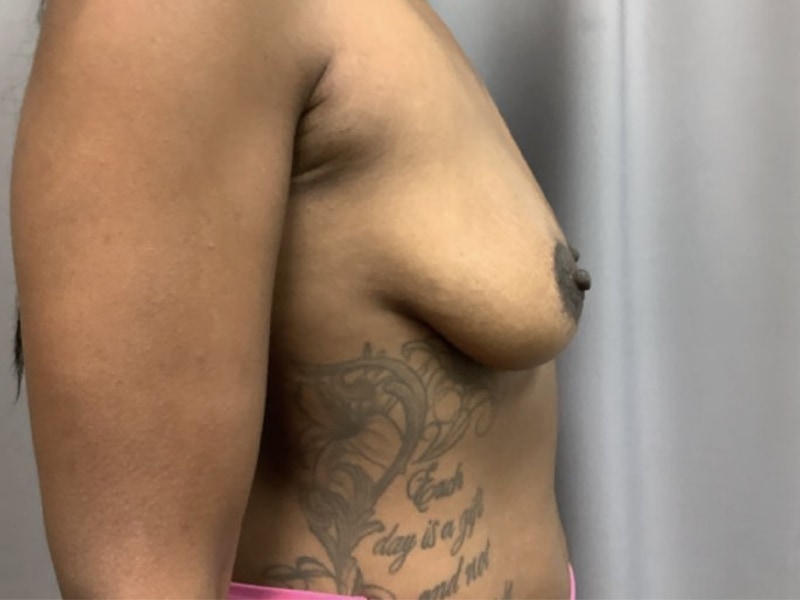 Breast Augmentation Before & After Image