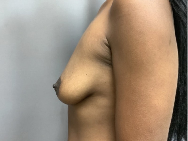 Breast Augmentation Before & After Image