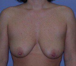 Breast Lift Before & After Image