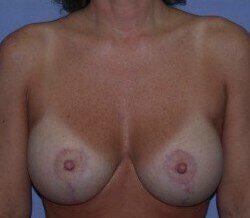 Breast Lift Before & After Image