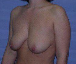 Breast Lift Before & After Image