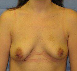 Breast Lift Before & After Image