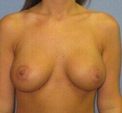 Breast Lift Before & After Image